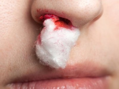 Penyebab Mimisan dan Cara Mengatasinya dengan Bahan&nbsp;Alami